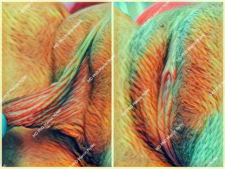 Labioplasty before & after - comprehensive photo results.