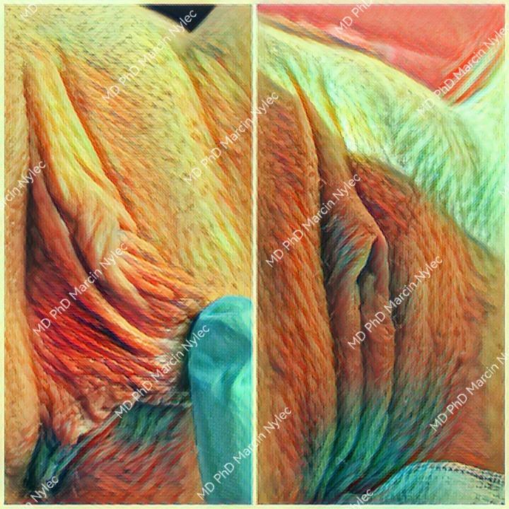 Labioplasty transformation - before and after aesthetic gynecology surgery.