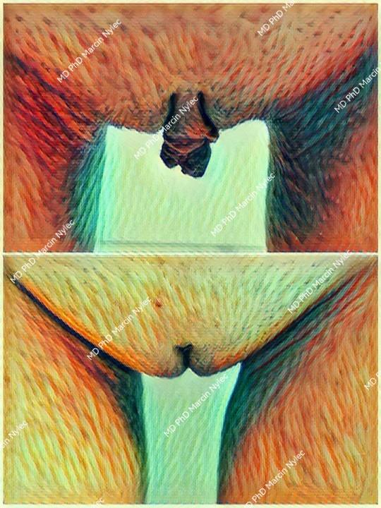 Labioplasty effects - before & after photos.