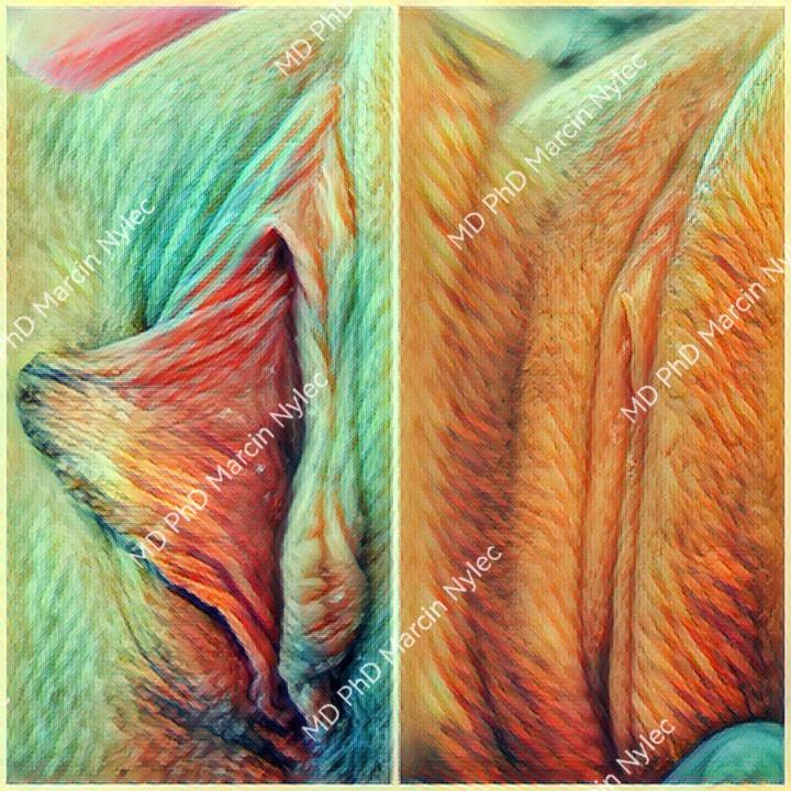 Aesthetic gynecology labioplasty - before and after surgery results.