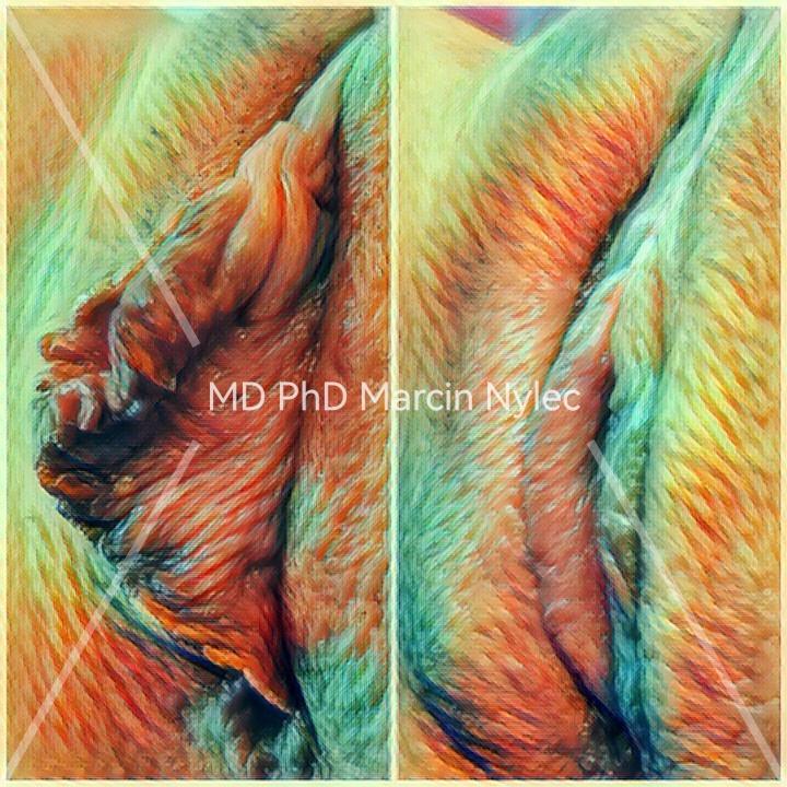 Labioplasty surgery results - before and after aesthetic gynecology.