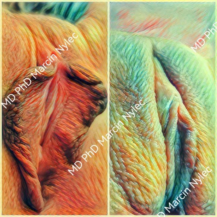 Labioplasty before and after - showcasing aesthetic gynecology.