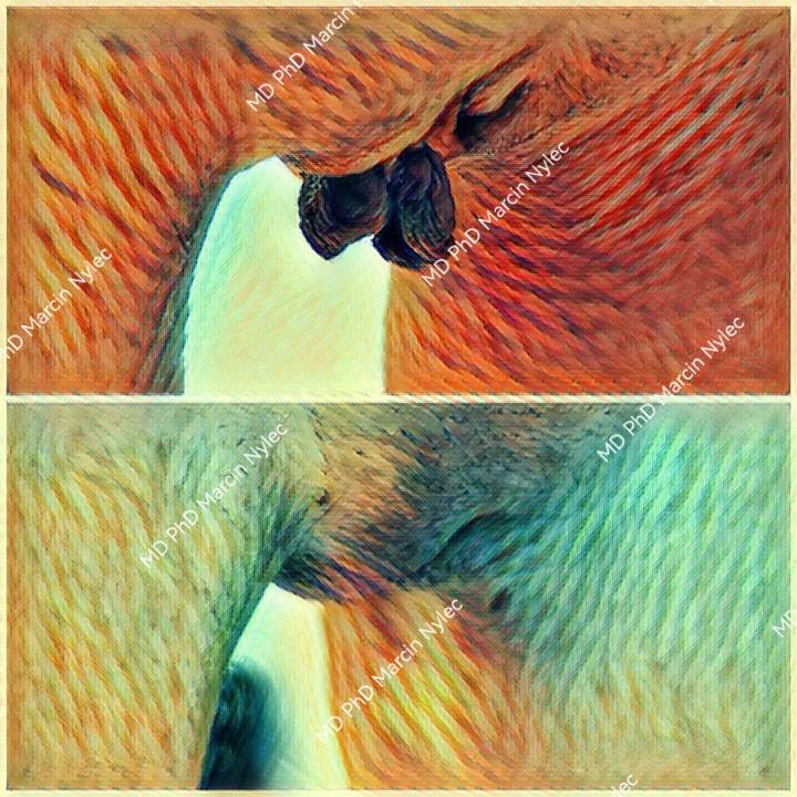 Before and after labioplasty - results of aesthetic gynecology.