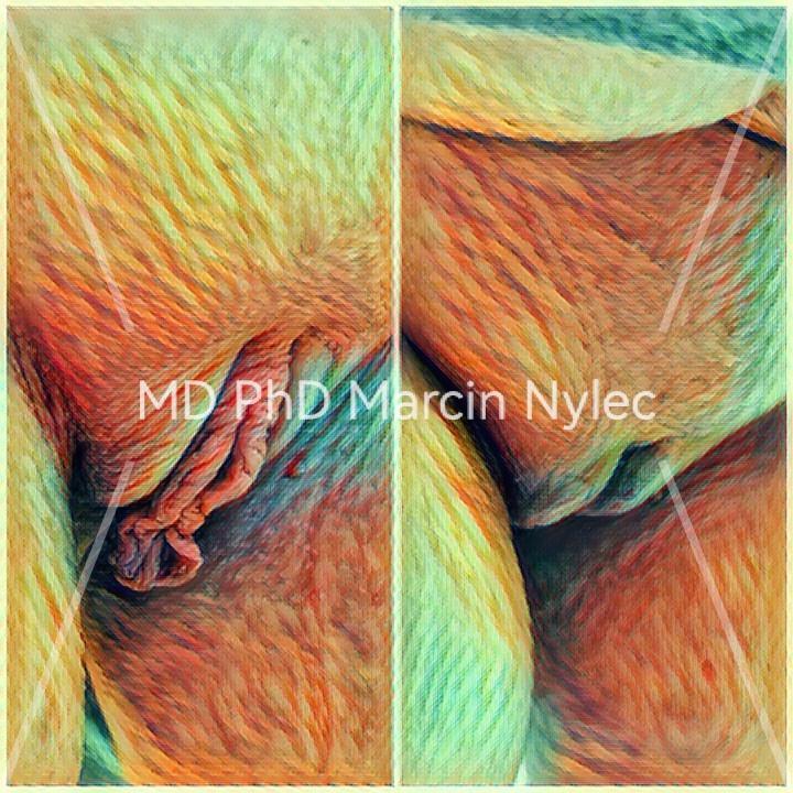Before and after labioplasty - aesthetic gynecology enhancements.