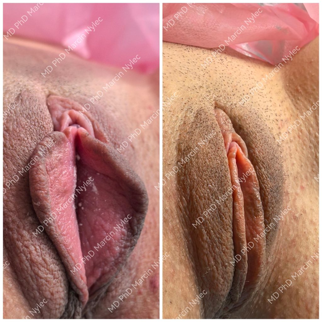 Before & After Labiaplasty Case 1002 View #1