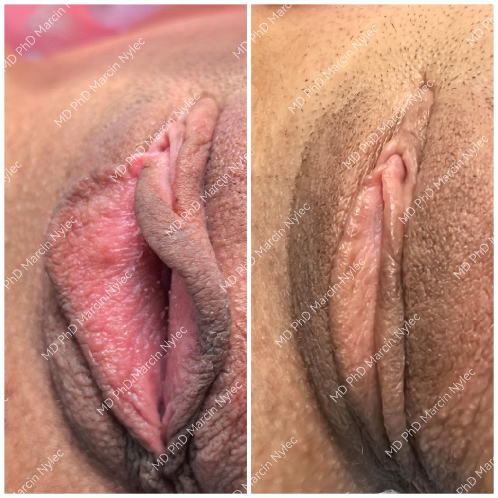 Before & After Labiaplasty Case 1002 View #4