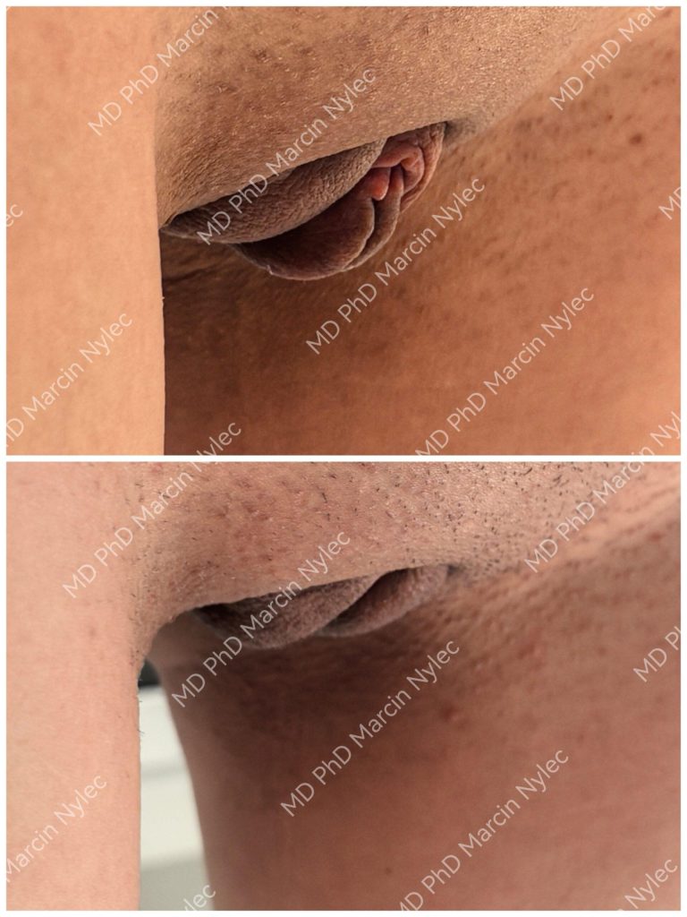 Before & After Labiaplasty Case 1002 Standing View #1