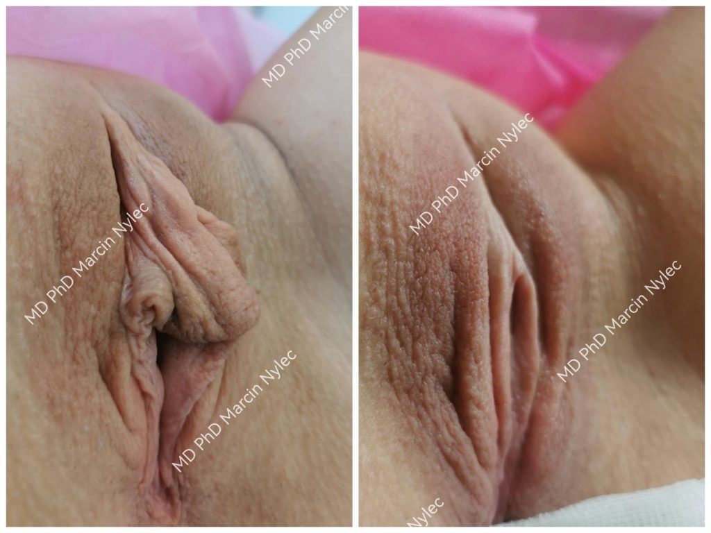 Before & After Labiaplasty Case 525 View #2