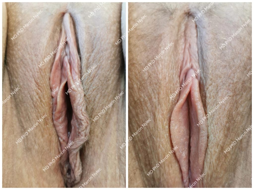 Before & After Labiaplasty Case 620 View #2
