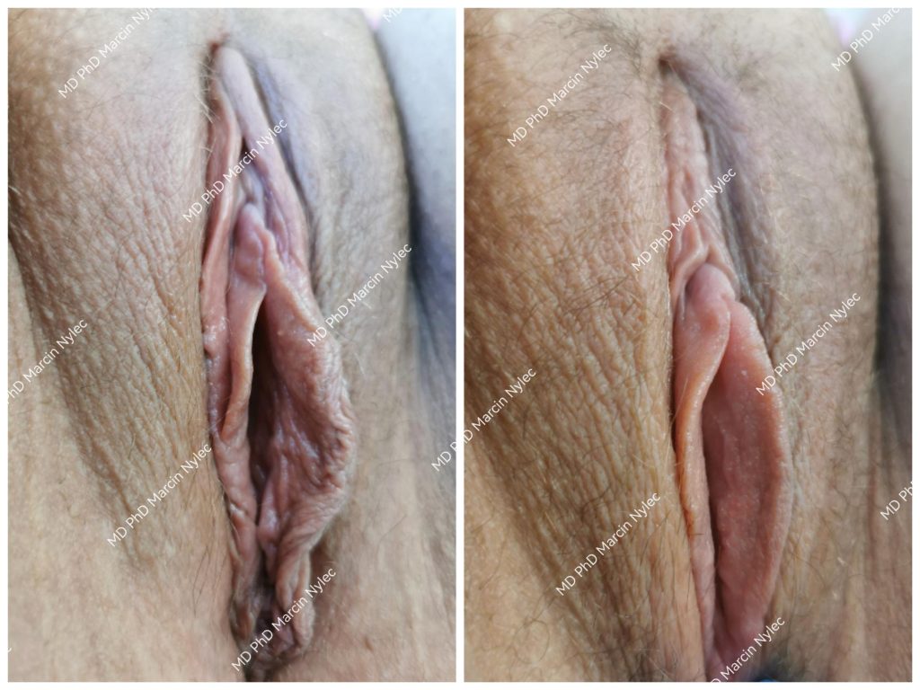 Before & After Labiaplasty Case 620 View #3